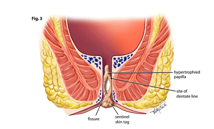 picture of anal fissure