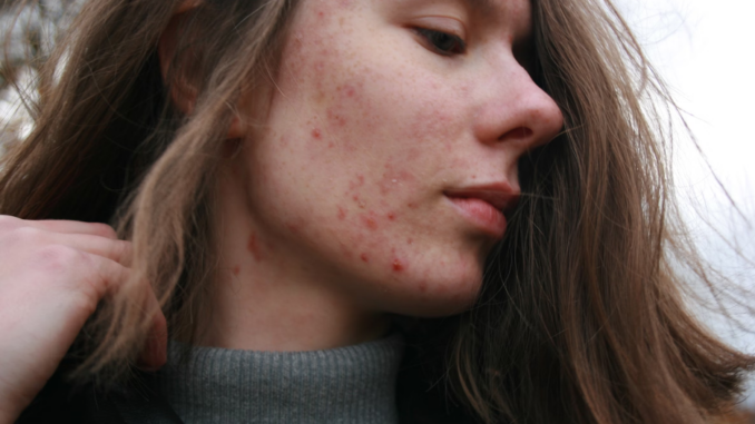 Acne Prone Skin photo